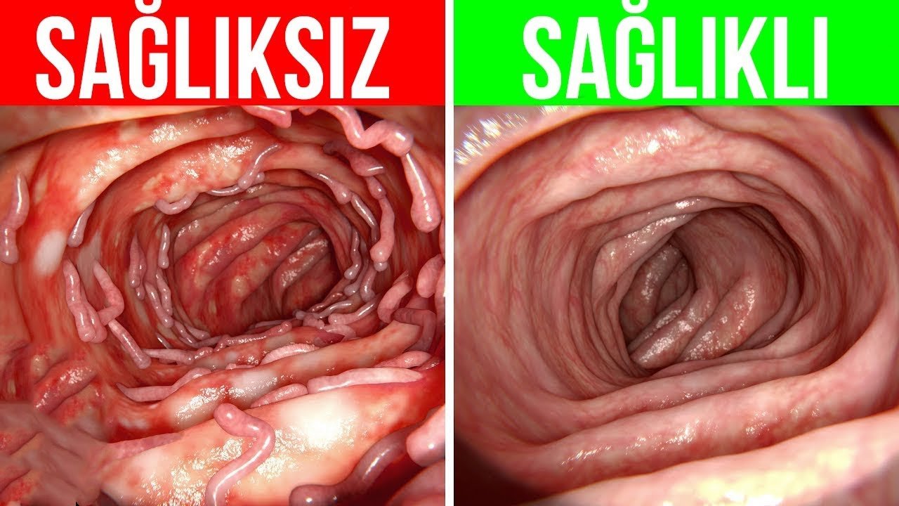 Bağırsak Kanseri Nedir? Belirtileri Ve Tedavisi » Bağırsak Kanseri Nedir? Belirtileri Ve Tedavisi »